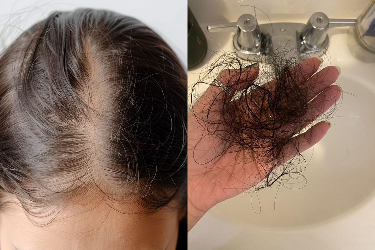 Was hilft bei Haarausfall durch die Abnehmspritze?